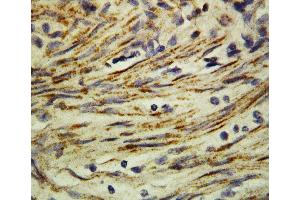 Anti-MMP16 antibody, IHC(P) IHC(P): Human Rectal Cancer Tissue