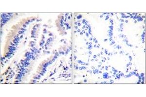 Immunohistochemistry analysis of paraffin-embedded human lung carcinoma tissue, using FADD (Ab-194) Antibody. (FADD anticorps  (AA 159-208))
