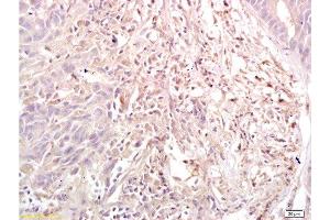 Formalin-fixed and paraffin embedded human gastric carcinoma labeled with Anti-Dnmt3a Polyclonal Antibody, Unconjugated  at 1:200, followed by conjugation to the secondary antibody and DAB staining (DNMT3A anticorps  (AA 26-100))