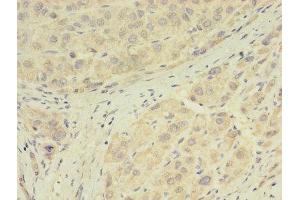 Immunohistochemistry of paraffin-embedded human liver cancer using ABIN7154076 at dilution of 1:100 (Glutathione Peroxidase 7 anticorps  (AA 28-187))