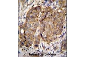 METTL2 Antibody (C-term) (ABIN655892 and ABIN2845293) immunohistochemistry analysis in formalin fixed and paraffin embedded human breast carcinoma followed by peroxidase conjugation of the secondary antibody and DAB staining.