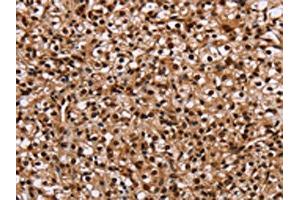 The image on the left is immunohistochemistry of paraffin-embedded Human prostate cancer tissue using ABIN7129718(HMGN5 Antibody) at dilution 1/20, on the right is treated with fusion protein. (HMGN5 anticorps)