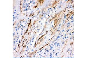 Anti- FAS Picoband antibody, IHC(P) IHC(P): Human Lung Cancer Tissue (FAS anticorps  (AA 26-173))