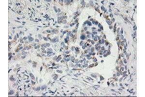 Immunohistochemical staining of paraffin-embedded Carcinoma of Human lung tissue using anti-SNAP25 mouse monoclonal antibody. (SNAP25 anticorps)