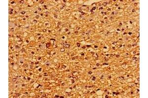 Immunohistochemistry of paraffin-embedded human glioma using ABIN7167523 at dilution of 1:100 (PTPRZ1 anticorps  (AA 36-300))