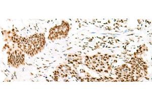 Immunohistochemistry of paraffin-embedded Human esophagus cancer tissue using TCOF1 Polyclonal Antibody at dilution of 1:50(x200) (TCOF1 anticorps)