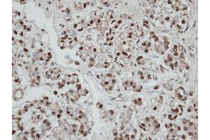 IHC-P Image Immunohistochemical analysis of paraffin-embedded human ovarian cancer, using SEPHS2, antibody at 1:100 dilution.