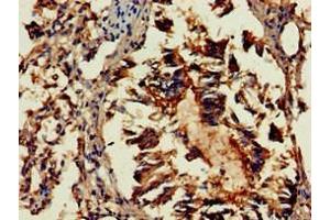 Immunohistochemistry of paraffin-embedded human lung tissue using ABIN7154436 at dilution of 1:100 (GAB2 anticorps  (AA 273-484))