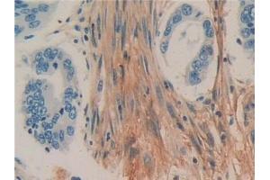 Detection of CD90 in Human Colorectal cancer Tissue using Polyclonal Antibody to Cluster of Differentiation 90 (CD90)