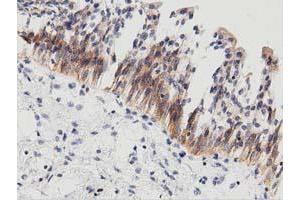 Immunohistochemical staining of paraffin-embedded Carcinoma of Human thyroid tissue using anti-PECR mouse monoclonal antibody. (PECR anticorps)
