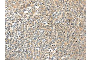 The image on the left is immunohistochemistry of paraffin-embedded Human ovarian cancer tissue using ABIN7192947(TSPYL6 Antibody) at dilution 1/20, on the right is treated with synthetic peptide. (TSPY-Like 6 anticorps)