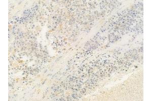 ABIN6263052 and ABIN6278809 at 1/100 staining human prostate carcinoma by IHC-P. (MAFB anticorps  (C-Term))