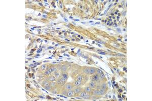Immunohistochemistry of paraffin-embedded human gastric cancer using PICK1 antibody. (PICK1 anticorps)