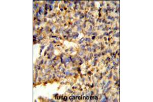 Formalin-fixed and paraffin-embedded human lung carcinoma reacted with FCGR2C Antibody , which was peroxidase-conjugated to the secondary antibody, followed by DAB staining. (FCGR2C anticorps  (C-Term))