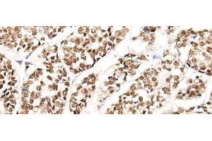 Immunohistochemistry of paraffin-embedded Human esophagus cancer tissue using HGH1 Polyclonal Antibody at dilution of 1:45(x200)