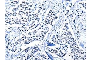 The image on the left is immunohistochemistry of paraffin-embedded Human breast cancer tissue using ABIN7191961(POU2AF1 Antibody) at dilution 1/15, on the right is treated with synthetic peptide. (POU2AF1 anticorps)