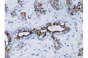 Immunohistochemistry of paraffin-embedded human breast cancer using BRCA1 antibody. (BRCA1 anticorps  (AA 120-220))