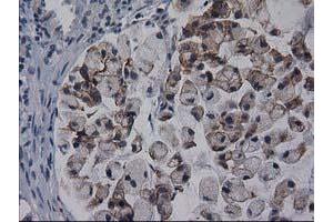 Immunohistochemical staining of paraffin-embedded Adenocarcinoma of Human colon tissue using anti-GPHN mouse monoclonal antibody.