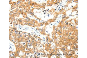 Immunohistochemistry of Human lung cancer using TRAF3 Polyclonal Antibody at dilution of 1:40
