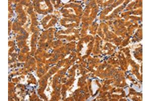 The image on the left is immunohistochemistry of paraffin-embedded Human thyroid cancer tissue using ABIN7192830(TNFRSF8 Antibody) at dilution 1/60, on the right is treated with synthetic peptide. (TNFRSF8 anticorps)