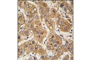 AP14244PU-N Apolipoprotein E antibody staining of Formalin-Fixed, Paraffin-Embedded Human Hepatocarcinoma tissue which was peroxidase-conjugated to the secondary antibody, followed by DAB staining.