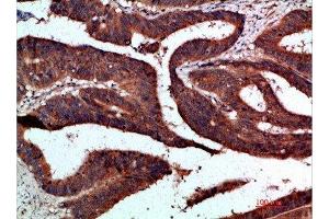Immunohistochemical analysis of paraffin-embedded human-colon-cancer, antibody was diluted at 1:200