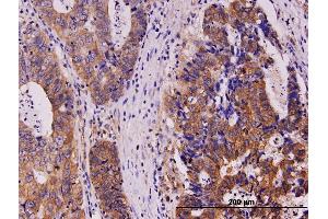Immunoperoxidase of monoclonal antibody to KIT on formalin-fixed paraffin-embedded human stomach carcinoma. (KIT anticorps  (AA 41-140))