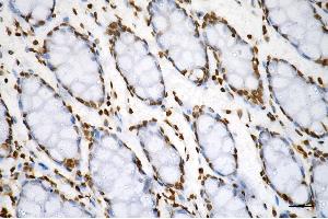 Immunohistochemistry was performed on paraffin-embedded human sigmoid colon carcinoma using histone H3 (di methyl K79) antibody (ABIN7798956), 1:200). (Recombinant Histone 3 anticorps  (H3K79me2))