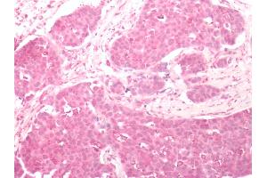Human Breast Carcinoma: Formalin-Fixed, Paraffin-Embedded (FFPE) (FZD2 anticorps  (N-Term))