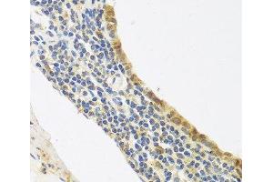 Immunohistochemistry of paraffin-embedded Human lung cancer using Endothelin 1 Polyclonal Antibody at dilution of 1:100 (40x lens). (Endothelin 1 anticorps)