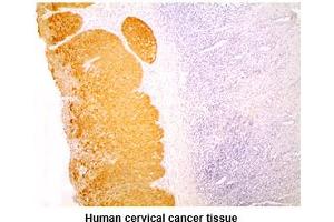 Paraffin embedded sections of human cervical cancer tissue were incubated with anti-human KRT14 (1:200) for 2 hours at room temperature. (KRT14 anticorps)