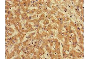 Immunohistochemistry of paraffin-embedded human liver cancer using ABIN7165226 at dilution of 1:100 (CUTA anticorps  (AA 33-150))