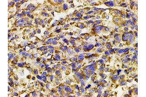 ABIN6267452 at 1/200 staining human osteosarcoma tissue sections by IHC-P.