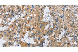 Immunohistochemistry of paraffin-embedded Human thyroid cancer using FGF9 Polyclonal Antibody at dilution of 1:40