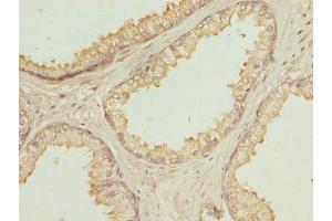 Immunohistochemistry of paraffin-embedded human prostate cancer using ABIN7162292 at dilution of 1:100 (OAZ1 anticorps  (AA 1-68))