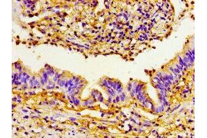 Immunohistochemistry of paraffin-embedded human lung cancer using ABIN7160458 at dilution of 1:100 (PRTN3 anticorps  (AA 1-170))