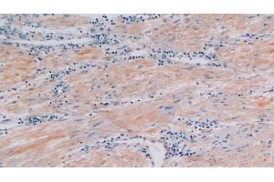 Detection of CTXI in Human Prostate Tissue using Polyclonal Antibody to Cross Linked C-Telopeptide Of Type I Collagen (CTXI) (CTX-I anticorps)