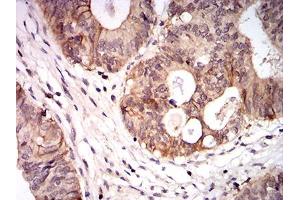 Immunohistochemical analysis of paraffin-embedded colon cancer tissues using CPV-VP2 mouse mAb with DAB staining. (CPV-VP2 (AA 1-128) anticorps)