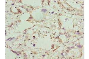 Immunohistochemistry of paraffin-embedded human pancreatic cancer using ABIN7154064 at dilution of 1:100 (GGTLC1 anticorps  (AA 1-225))