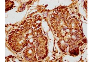 IHC image of ABIN7150773 diluted at 1:200 and staining in paraffin-embedded human breast cancer performed on a Leica BondTM system.