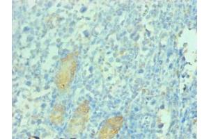 Immunohistochemical of paraffin-embedded human gastric cancer tissue using ABIN7163025 at dilution of 1:200 (PGC anticorps)