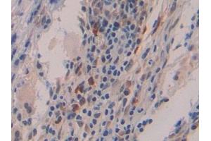 Detection of IFNb in Human Skin cancer Tissue using Polyclonal Antibody to Interferon Beta (IFNb)