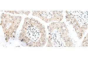 Immunohistochemistry of paraffin-embedded Human liver cancer tissue using NGEF Polyclonal Antibody at dilution of 1:35(x200) (NGEF anticorps)