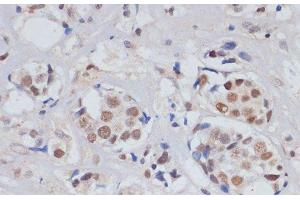 Immunohistochemistry of paraffin-embedded Human breast cancer using SKIV2L2 Polyclonal Antibody at dilution of 1:100 (40x lens). (MTR4 anticorps)