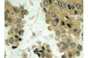 Immunohistochemistry analysis of Akt2 antibody in paraffin-embedded human lung carcinoma tissue. (AKT2 anticorps)