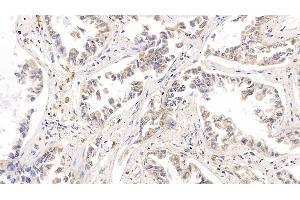 Detection of RRM1 in Human Lung cancer Tissue using Polyclonal Antibody to Ribonucleotide Reductase M1 (RRM1)