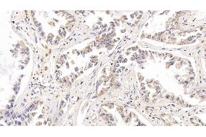 Detection of RRM1 in Human Lung cancer Tissue using Polyclonal Antibody to Ribonucleotide Reductase M1 (RRM1) (RRM1 anticorps  (AA 1-213))