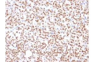 IHC testing of FFPE human thyroid carcinoma with PAX8 antibody (clone PAX8/1492).