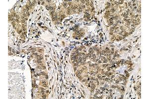 ABIN7095525 and ABIN7099582 at 1/100 staining human lung cancer and adjacent non-tumor tissue by IHC-P. (WDR77 anticorps)
