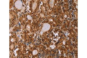 Immunohistochemistry of Human ovarian cancer using IHH Polyclonal Antibody at dilution of 1:50
